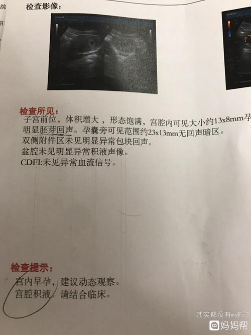 陶氏-陶氏腔积液是什么意思
